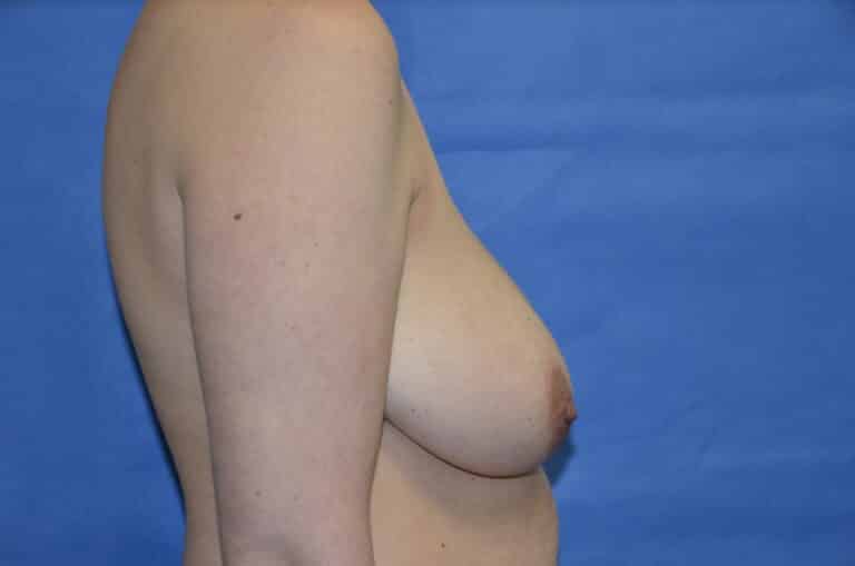 Before Image: Breast Lift - right-side