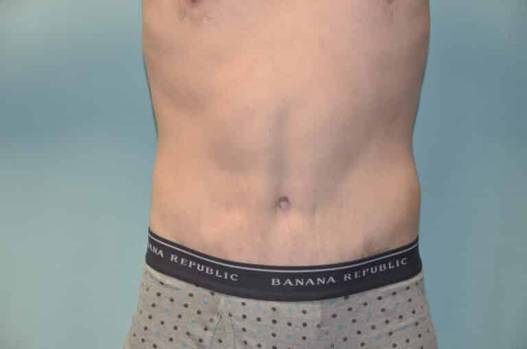 After Image: Tummy Tuck - front