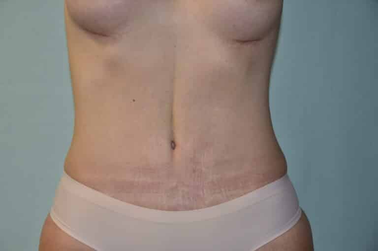 After Image: Tummy Tuck - front