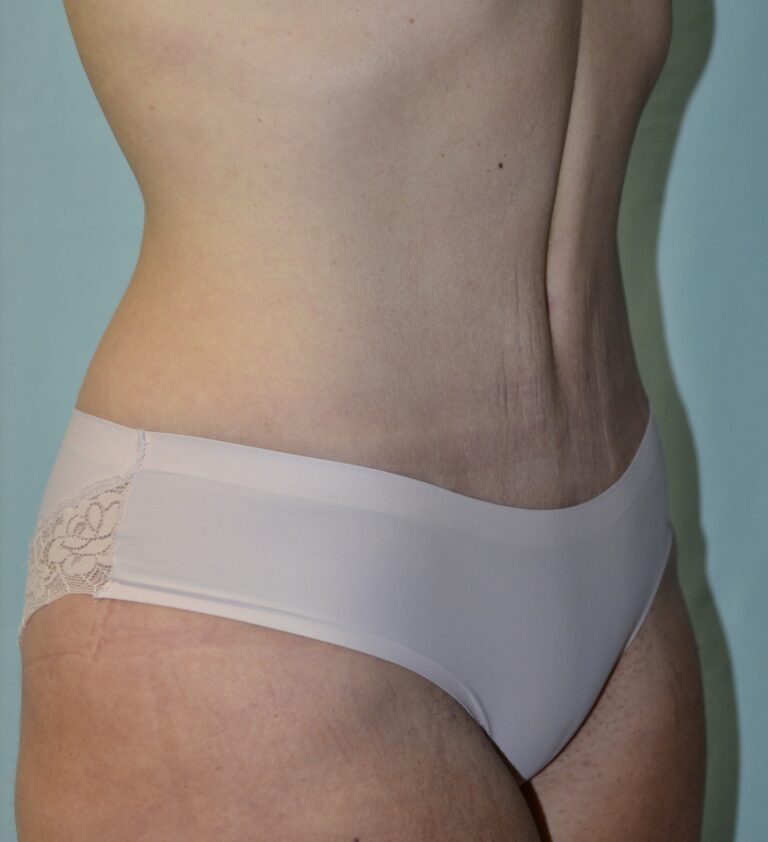 After Image: Tummy Tuck - right-front-oblique