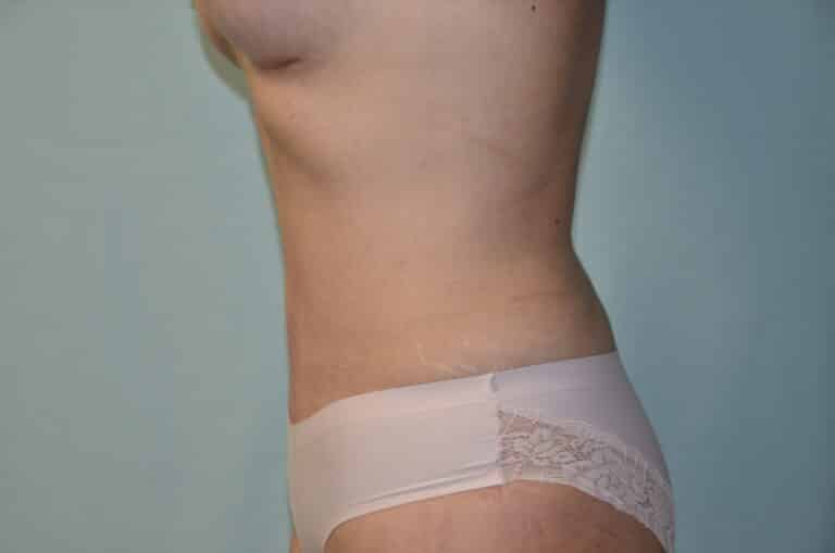 After Image: Tummy Tuck - left-side