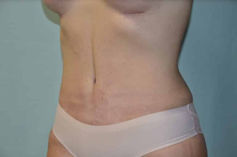 After Image: Tummy Tuck - left-front-oblique