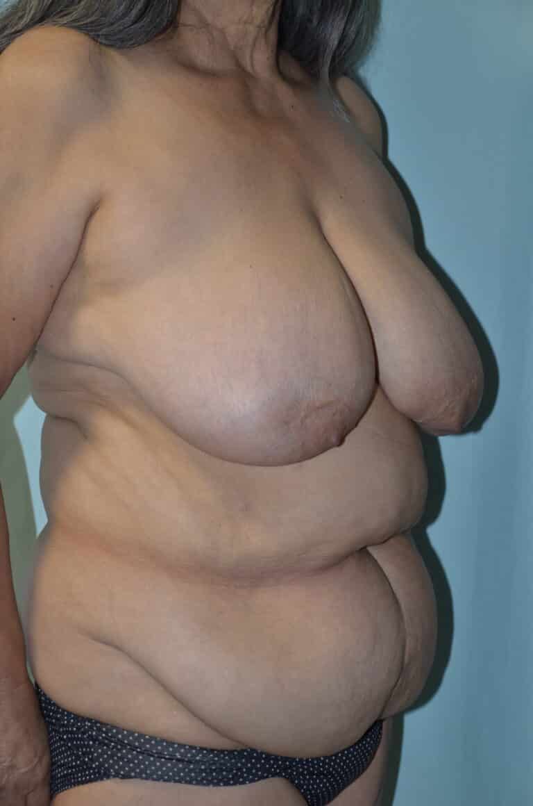 Before Image: Mommy Makeover - right-front-oblique