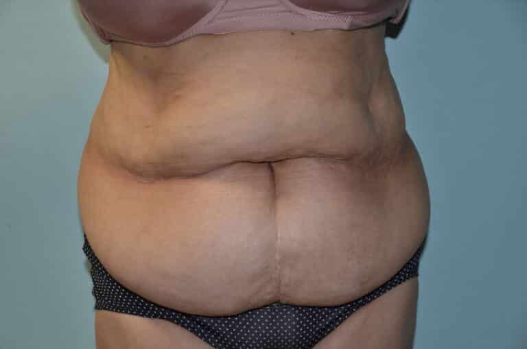 Before Image: Tummy Tuck - front