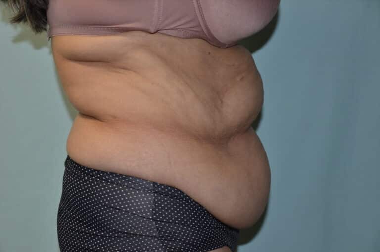 Before Image: Tummy Tuck - right-side