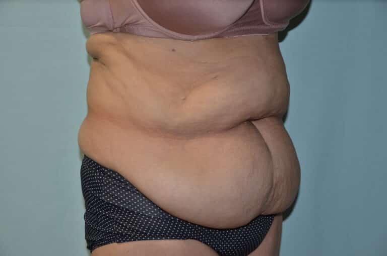 Before Image: Tummy Tuck - right-front-oblique