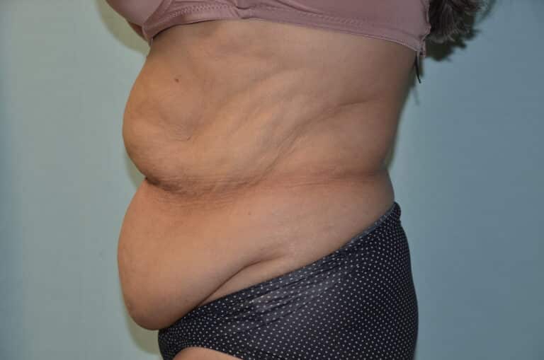 Before Image: Tummy Tuck - left-side