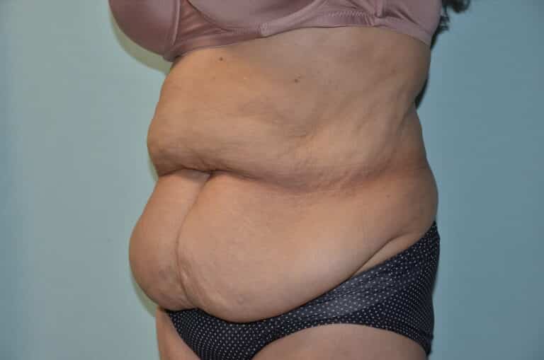 Before Image: Tummy Tuck - left-front-oblique