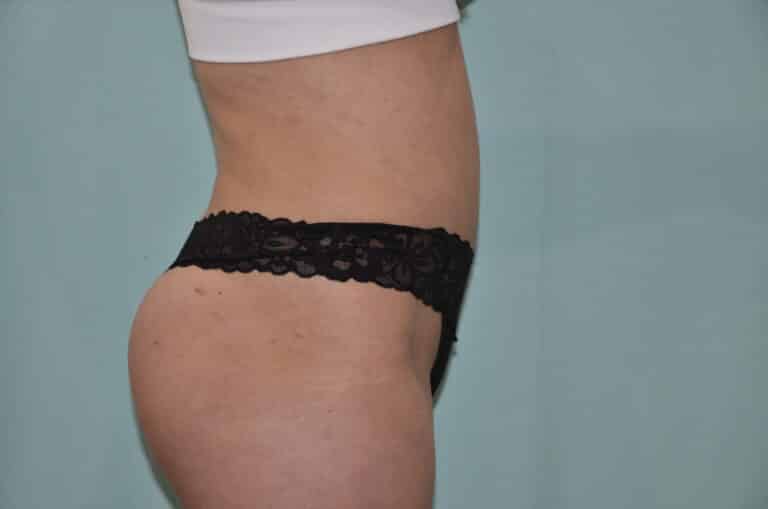 After Image: Tummy Tuck - right-side