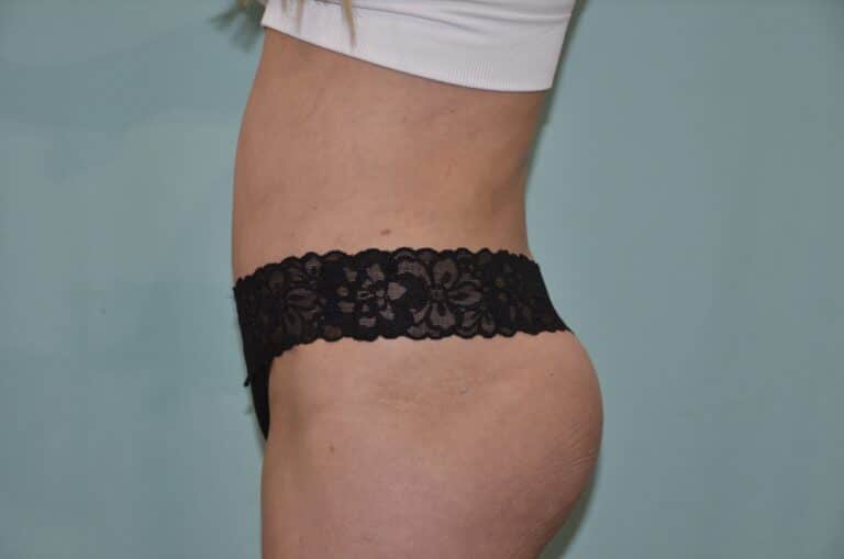 After Image: Tummy Tuck - left-side