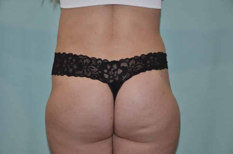 After Image: Tummy Tuck - back