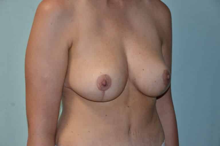 After Image: Breast Lift - right-front-oblique