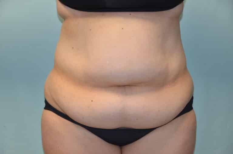 Before Image: Tummy Tuck - front