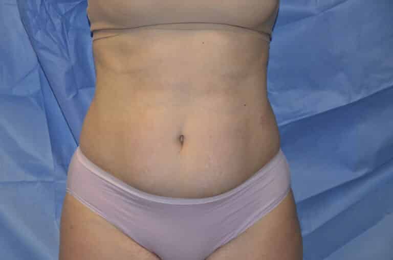 Before Image: Tummy Tuck - front