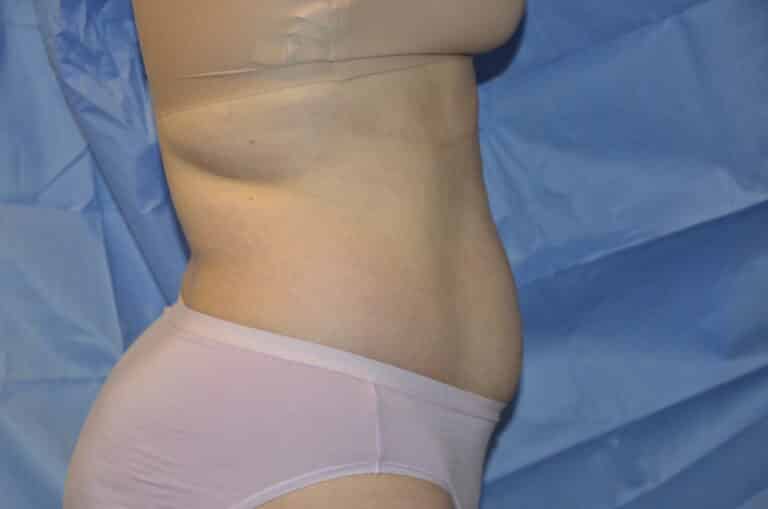 Before Image: Tummy Tuck - right-side