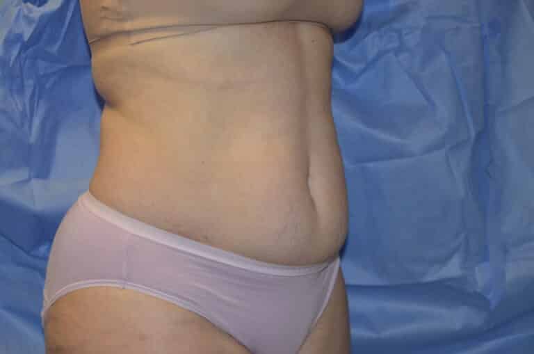 Before Image: Tummy Tuck - right-front-oblique