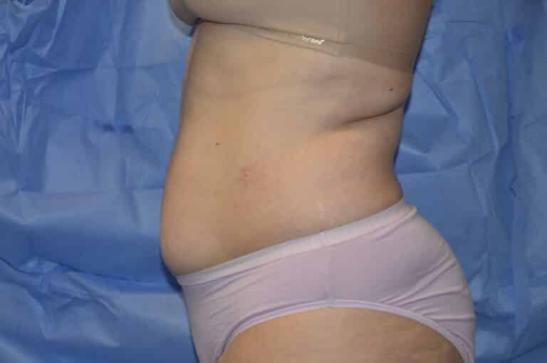 Before Image: Tummy Tuck - left-side