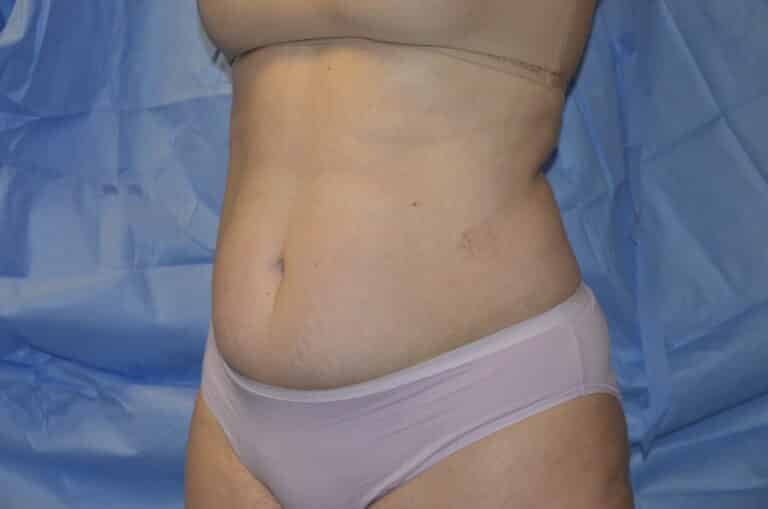 Before Image: Tummy Tuck - left-front-oblique