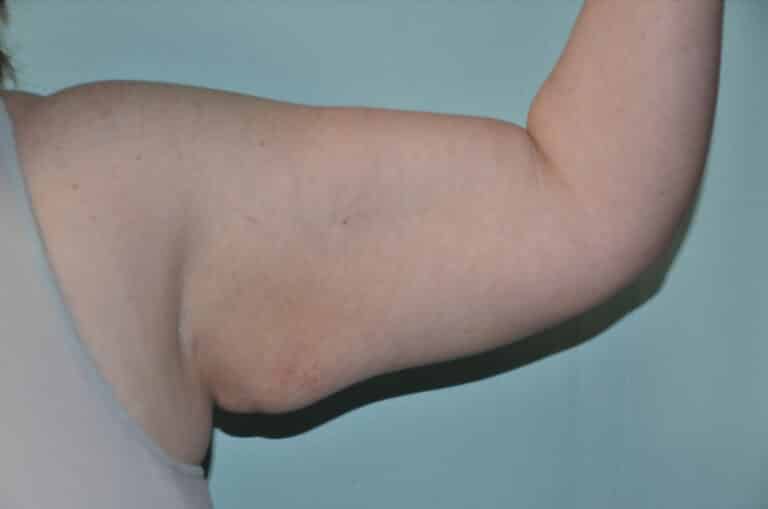 Before Image: Brachioplasty - front