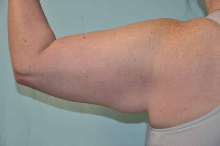 Before Image: Brachioplasty - back