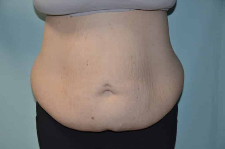 Before Image: Tummy Tuck - front