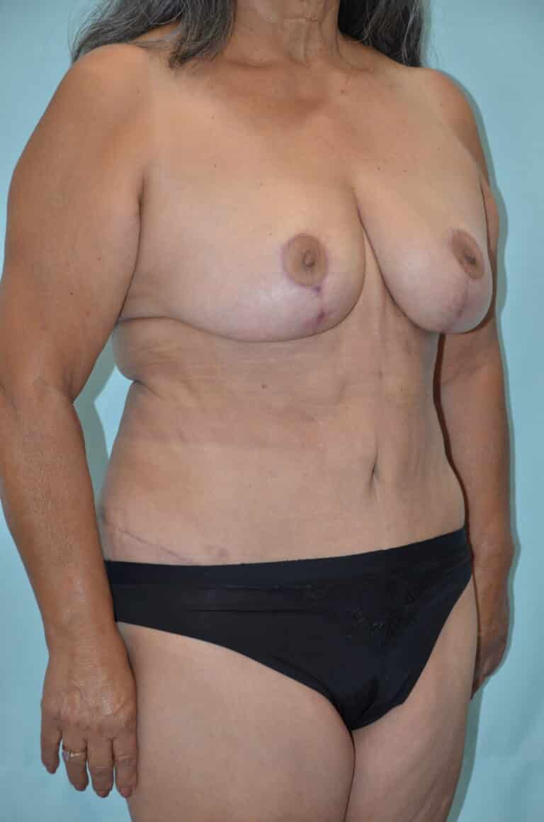 After Image: Mommy Makeover - right-front-oblique