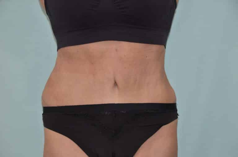 After Image: Tummy Tuck - front