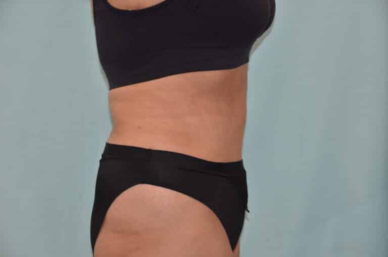 After Image: Tummy Tuck - right-side