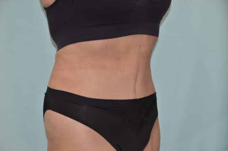 After Image: Tummy Tuck - right-front-oblique