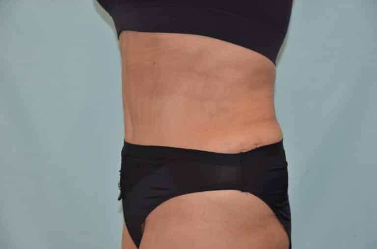 After Image: Tummy Tuck - left-side