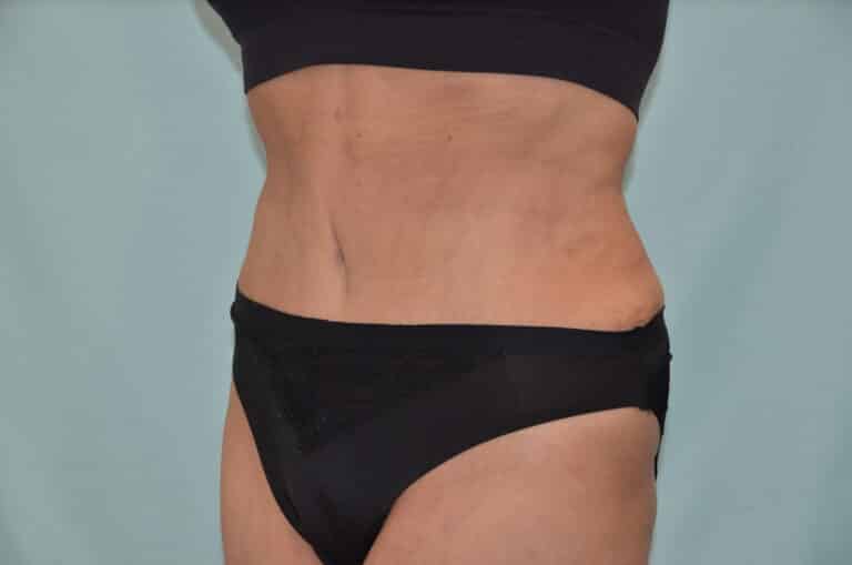 After Image: Tummy Tuck - left-front-oblique