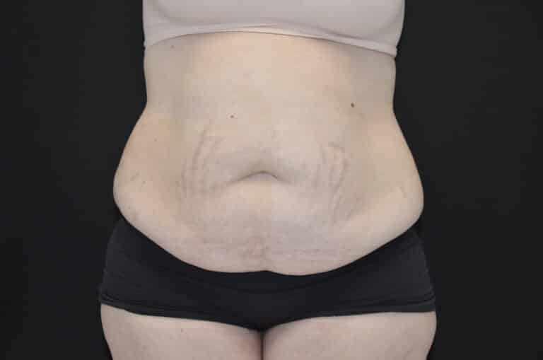 Before Image: Tummy Tuck - front