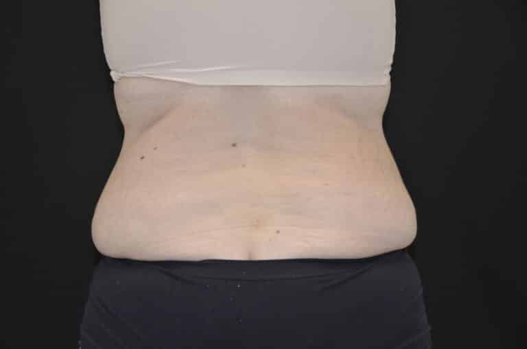 Before Image: Tummy Tuck - back