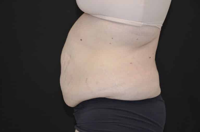 Before Image: Tummy Tuck - left-side