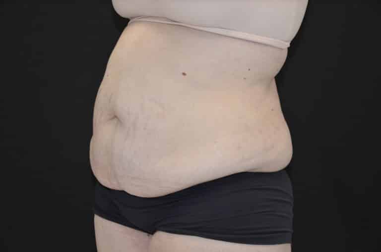 Before Image: Tummy Tuck - left-front-oblique