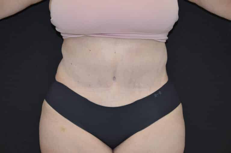 After Image: Tummy Tuck - front