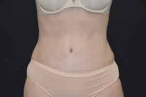 After Image: Tummy Tuck