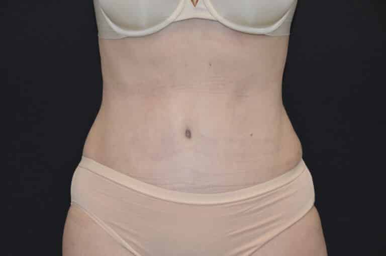 After Image: Tummy Tuck - front