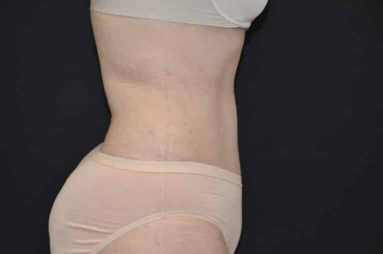 After Image: Tummy Tuck - right-side