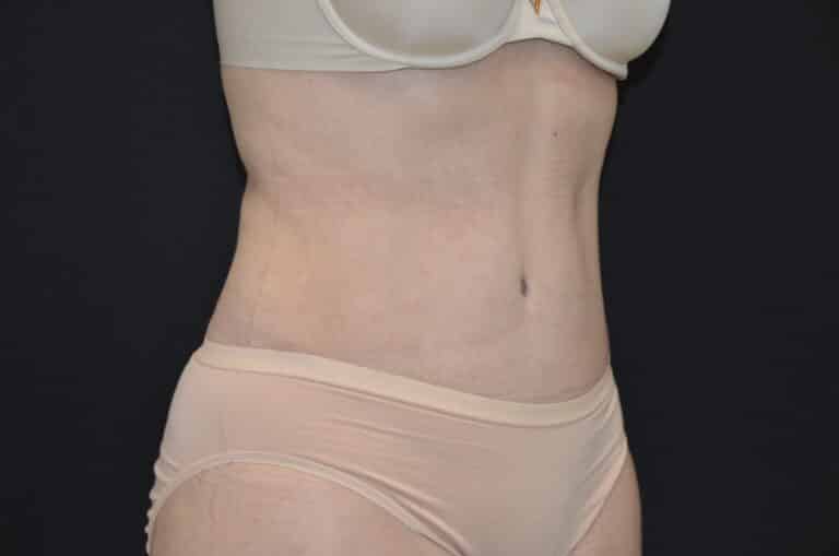 After Image: Tummy Tuck - right-front-oblique