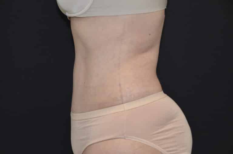 After Image: Tummy Tuck - left-side