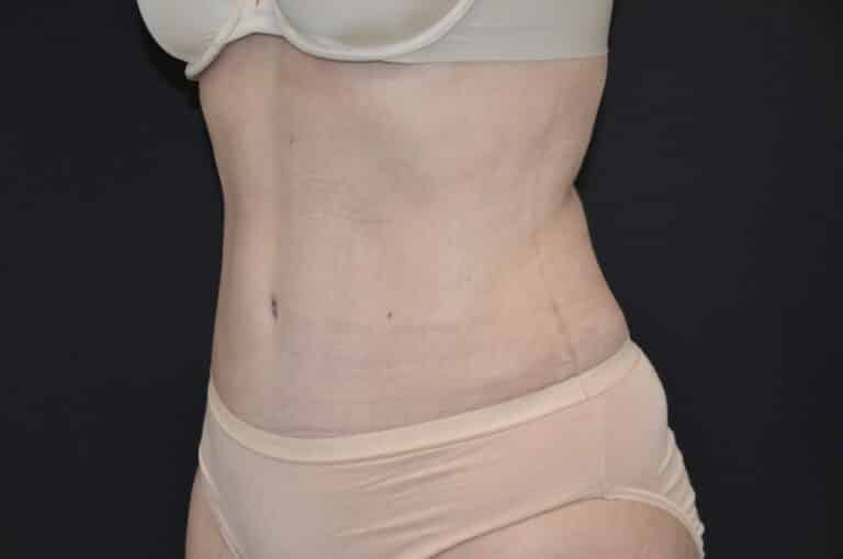 After Image: Tummy Tuck - left-front-oblique