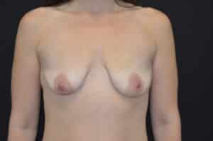 Before Image: Breast Lift