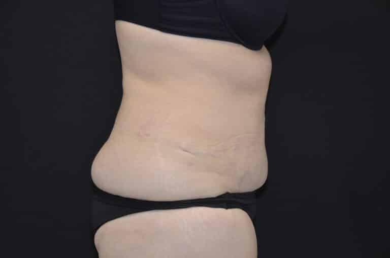 Before Image: Tummy Tuck - right-side