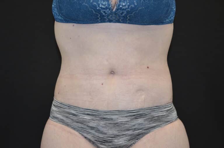 After Image: Tummy Tuck - front