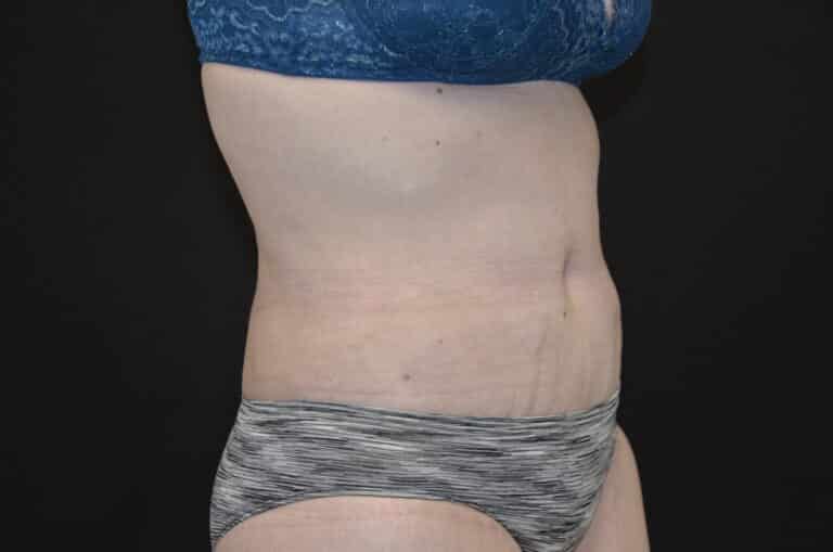 After Image: Tummy Tuck - right-front-oblique