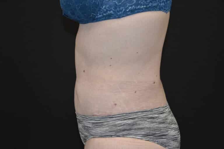 After Image: Tummy Tuck - left-side