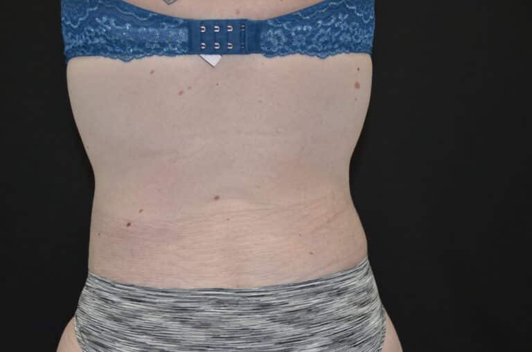 After Image: Tummy Tuck - back