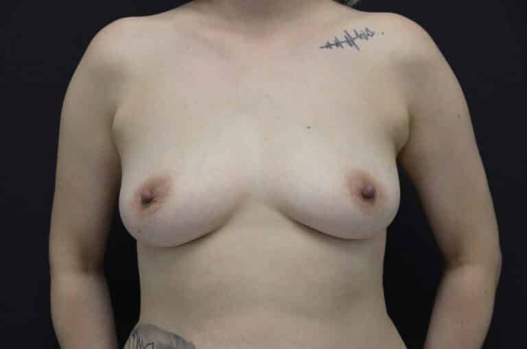 Before Image: Breast Augmentation - front