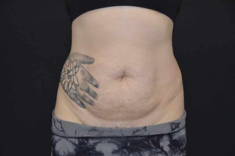 Before Image: Tummy Tuck - front